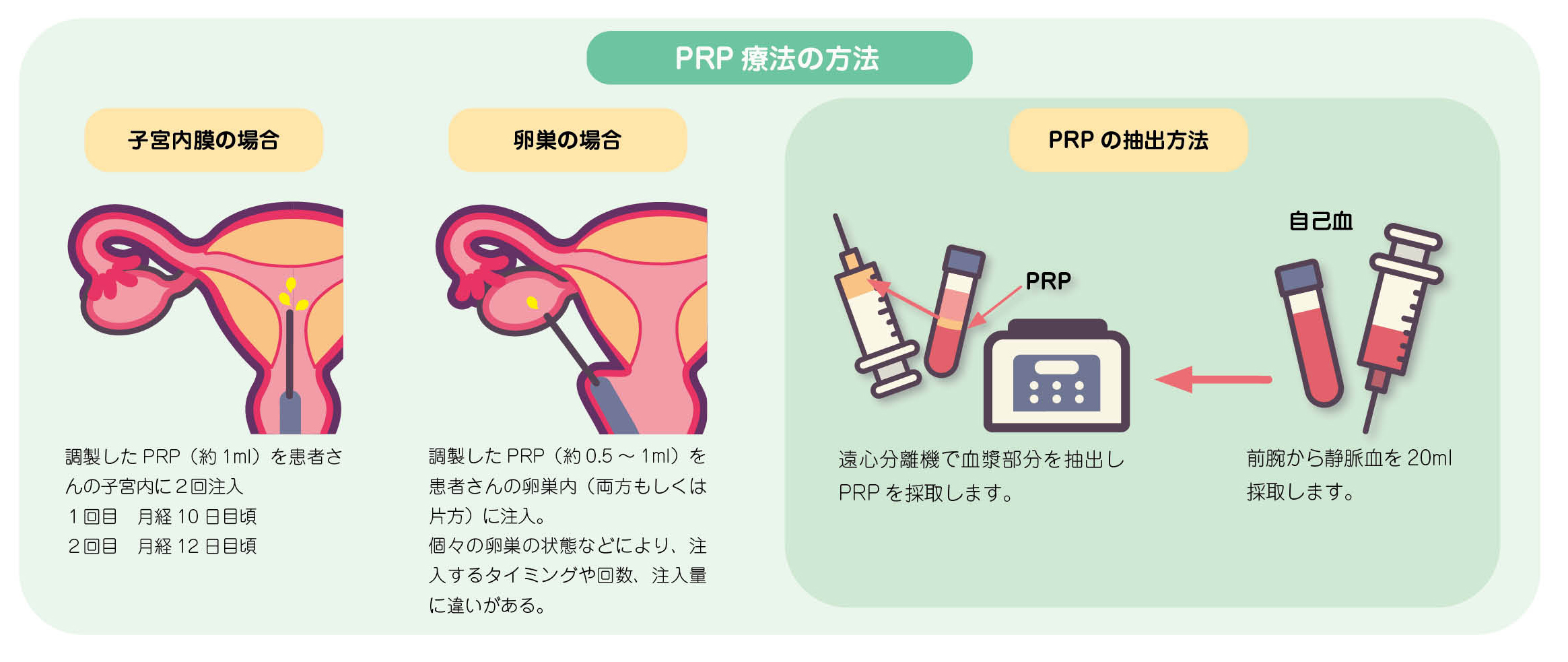 PRP治療の方法